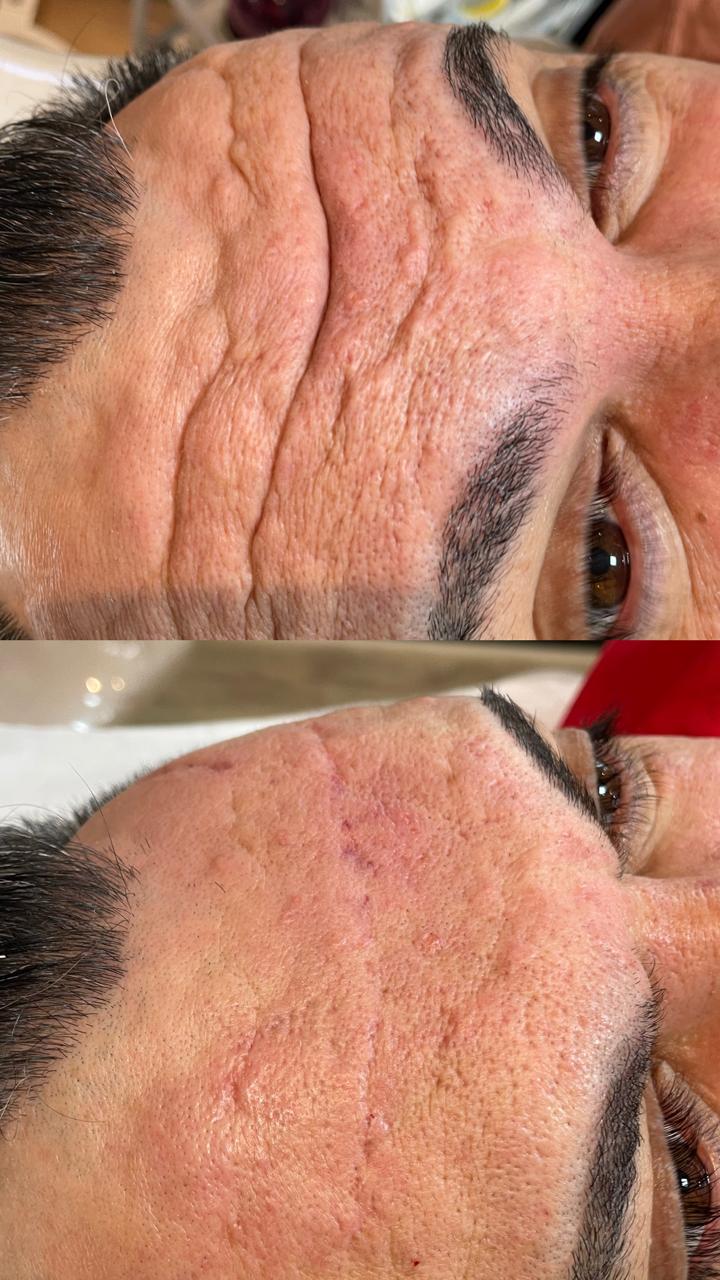 Antes e depois — Botox masculino