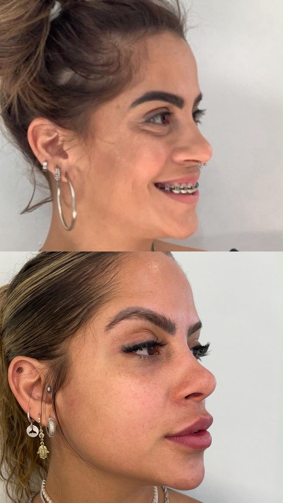 Antes e depois — Harmonização facial