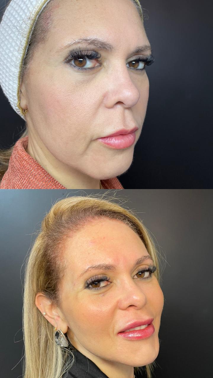 Antes e depois — Harmonização facial