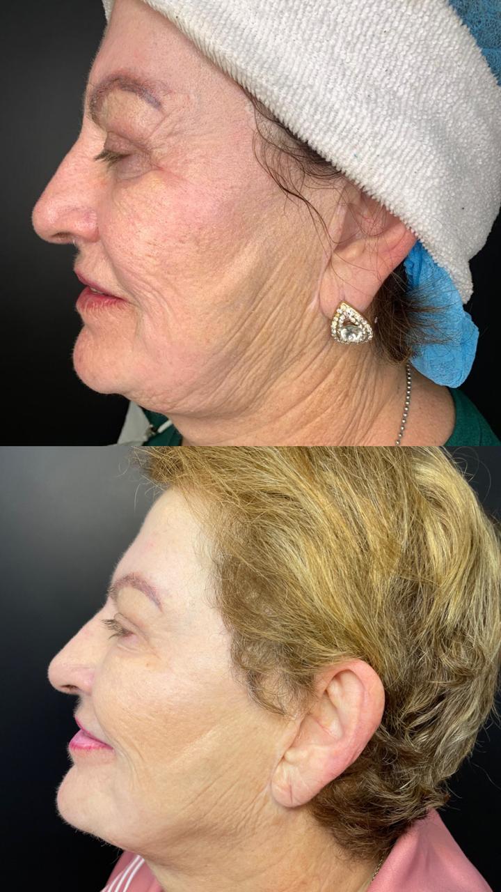 Antes e depois — Peeling CO2