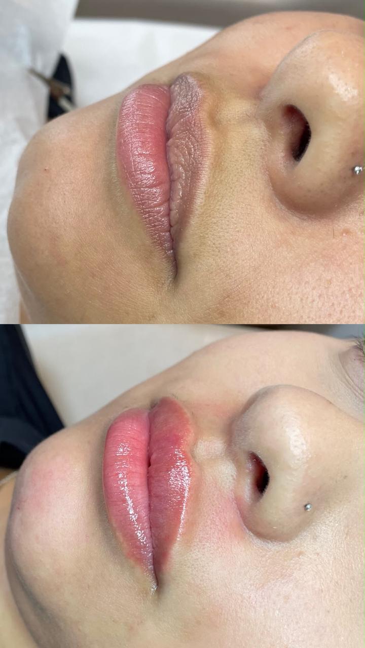Antes e depois — Preenchimento labial