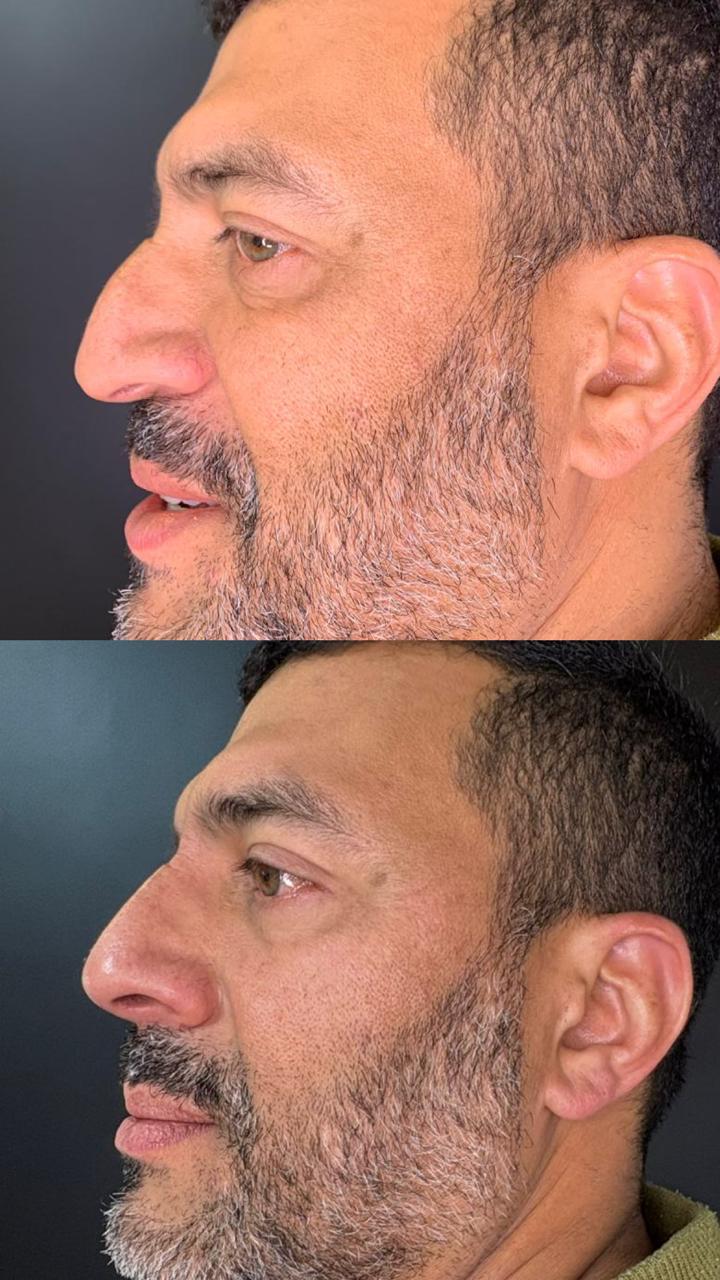 Antes e depois — Rinomodelação masculina