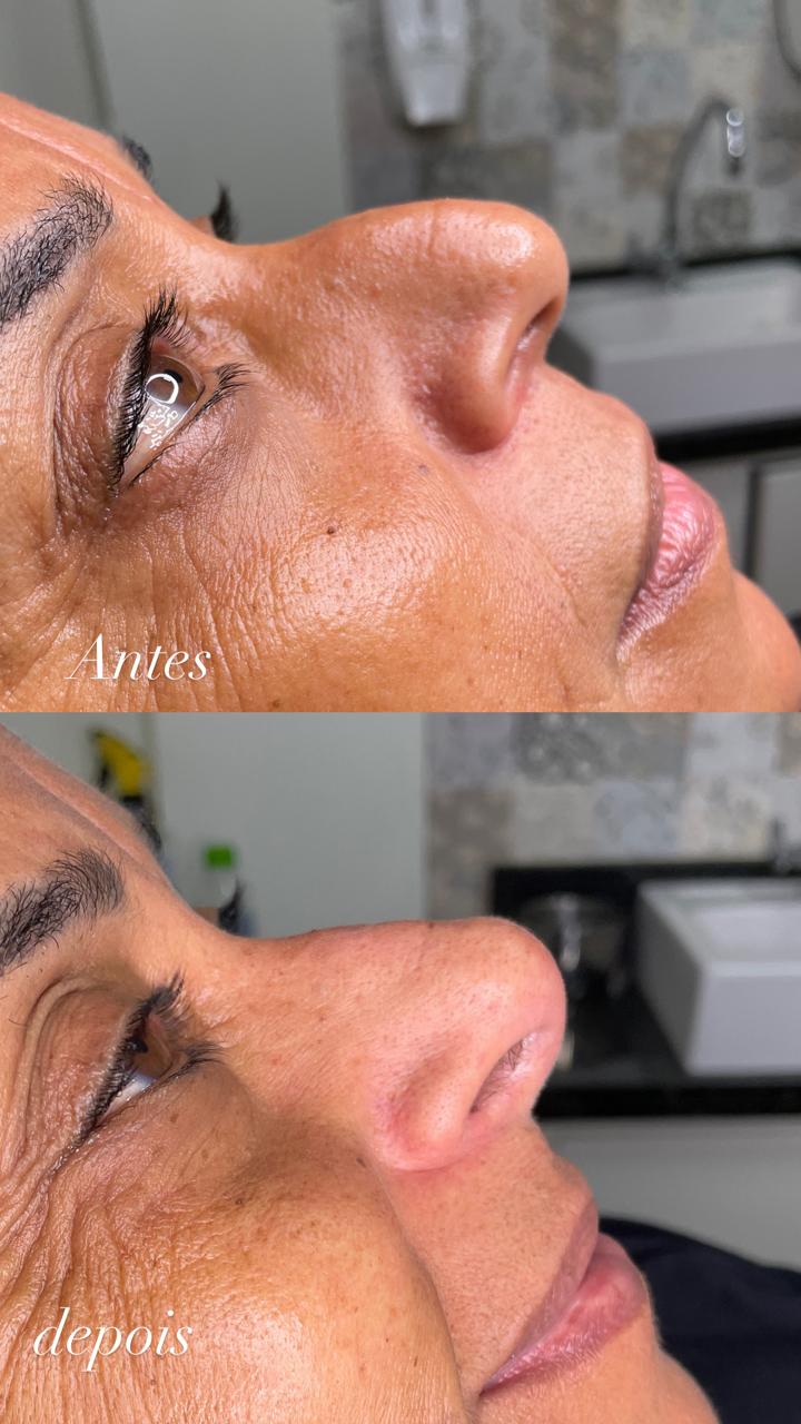 Antes e depois — Rinomodelação