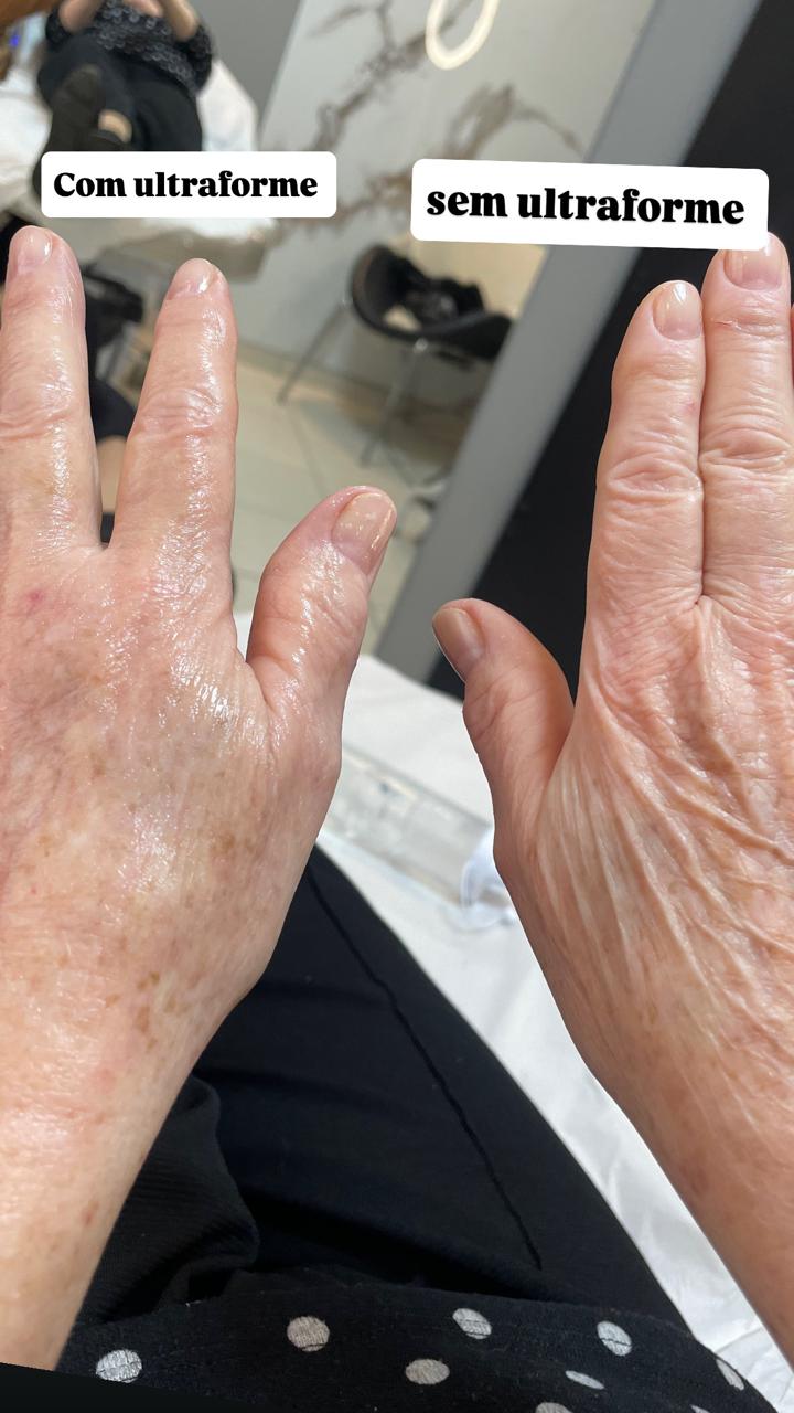 Antes e depois — Ultraforme