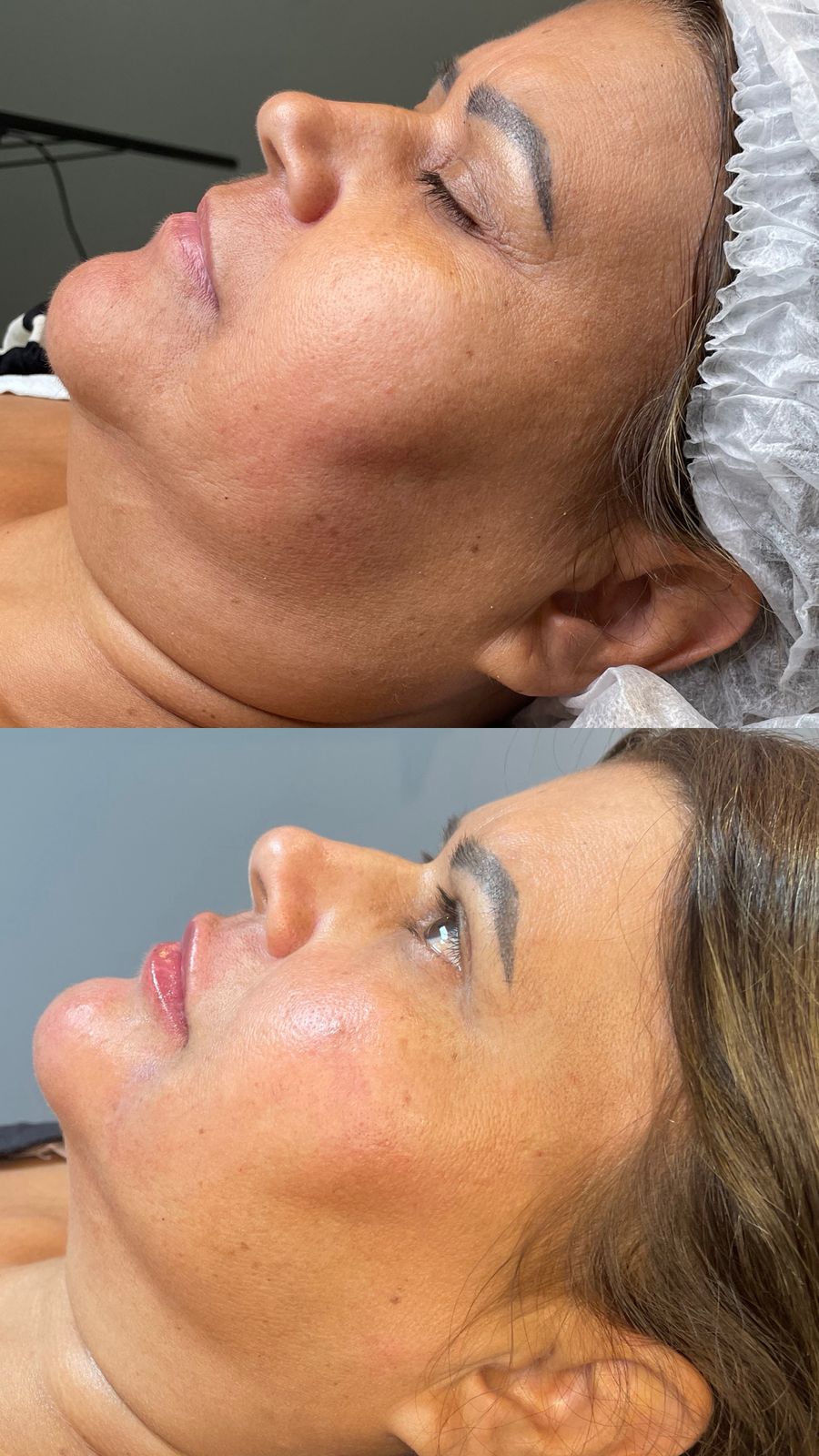 Antes e depois — Ultraforme